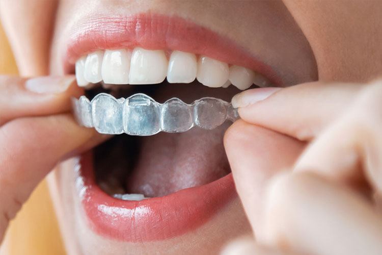What are the benefits of clear aligners for kids and teens
